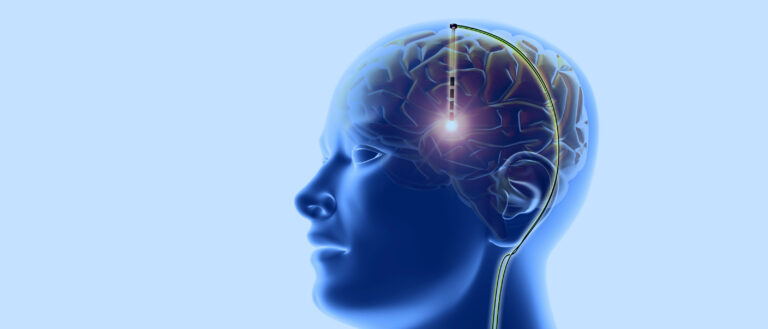 Ученые разработали методику "включения/выключения" сознания путем электростимуляции мозга